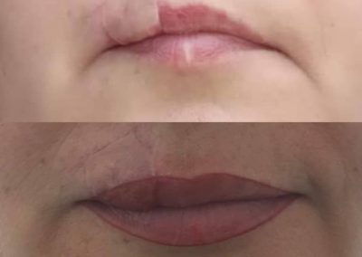Ricostruzione labbro dermopigmentazione