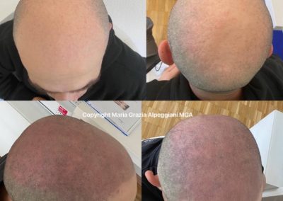 Tricopigmentazione Alopecia Androgenetica-min