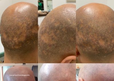 alopecia areata copertura tricopigmentazione