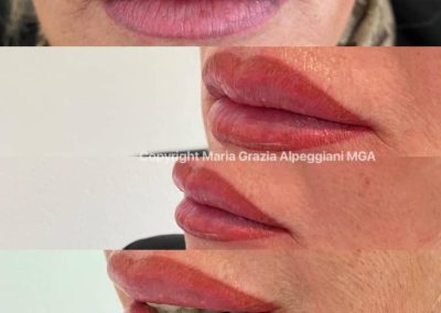 correzione labbra nere dermopigmentazione