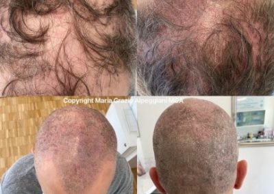 tricopigmentazione su alopecia androgenetica uomo-min
