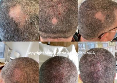 tricopigmentazione su alopecia areata-min