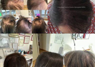 copertura tricopigmentazione donna alopecia
